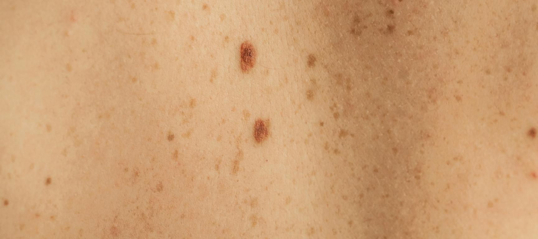 tipologie di melanoma