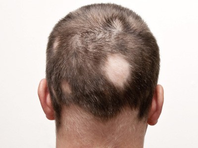IMG-Caduta-capelli-e-alopecia